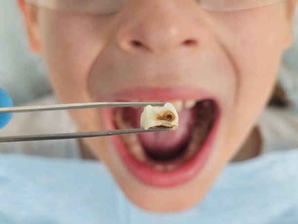 Best Dentist for Tooth Abscess  in West Wyomissing, PA